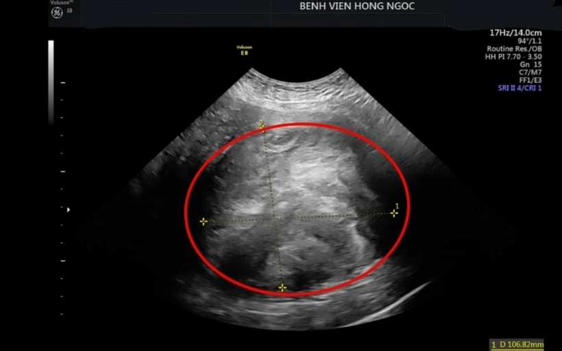 Các bác sĩ xác định khối u có kích thước lớn, nhiều mạch máu tăng sinh và lan sâu vào thành tử cung, gây chèn ép bàng quang và trực tràng. Ảnh: Gia Đình Việt Nam