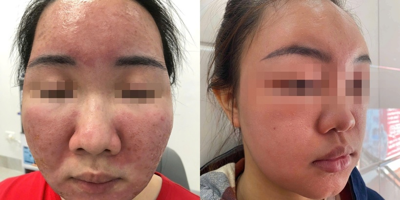 Sử dụng mỹ phẩm không rõ nguồn gốc, bán tràn lan trên mạng, nhiều người bỏng da, hỏng mặt. Ảnh: BSCC