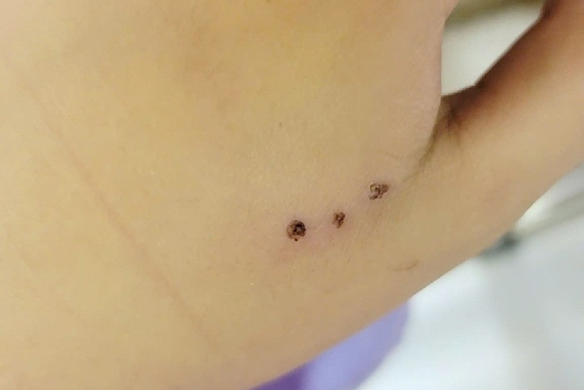 Chuột cắn gây sưng đau nghiêm trọng, bé trai 10 tuổi phải nhập viện. Ảnh: BVCC.