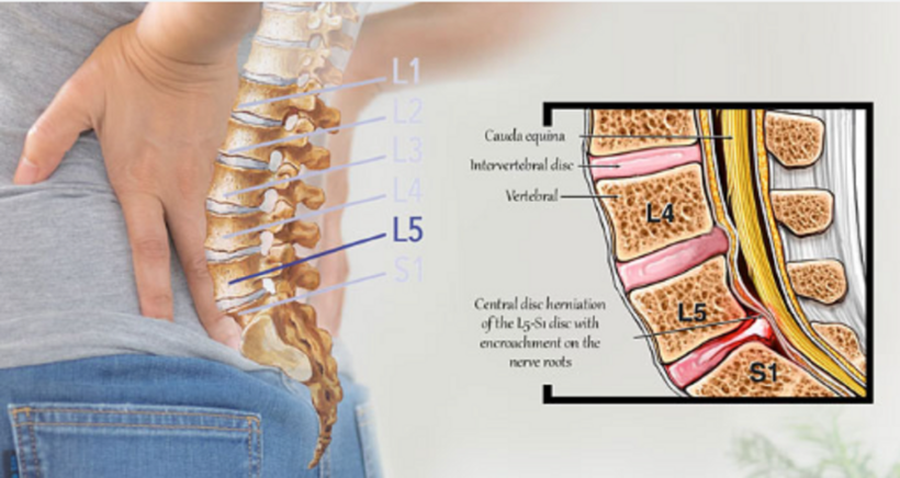 Thoát vị đĩa đệm L5 S1 gây đau vùng lưng dưới.