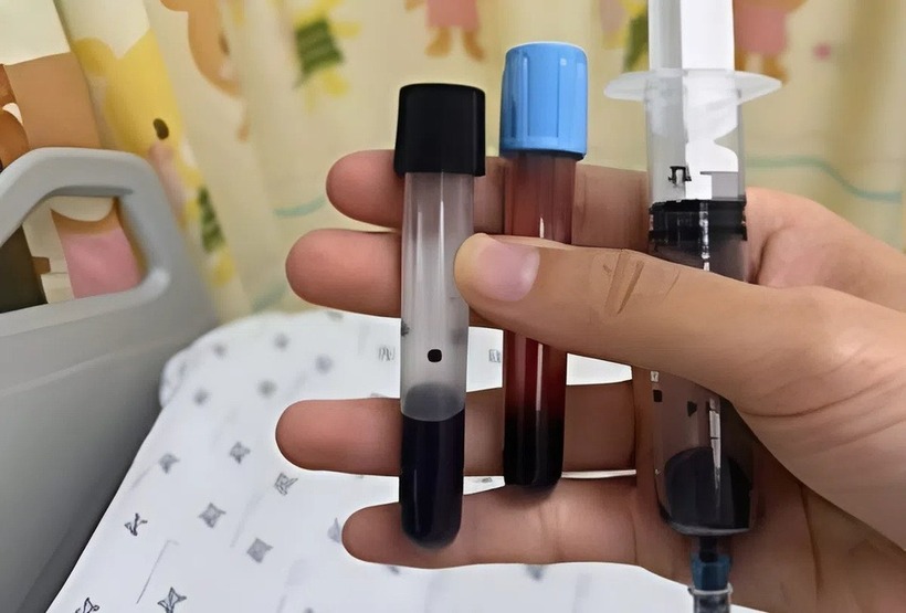 Máu bệnh nhi có màu đen và không đổi màu khi lắc mạnh. Ảnh: Tạp chí Tri thức.