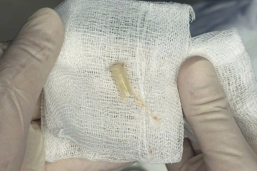 Dị vật hình ống dài 10mm mắc kẹt ở phế quản gốc trái của bé. Ảnh: Báo Dân trí.