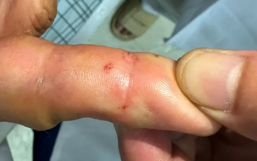 Người phụ nữ bị rắn hổ mang cắn vào tay. Ảnh: Thời báo VTV