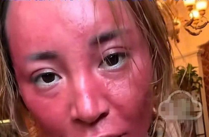 Toàn bộ khuôn mặt sưng đỏ, nổi mẩn, bỏng rát và ngứa ngáy dữ dội. Ảnh: Weibo.