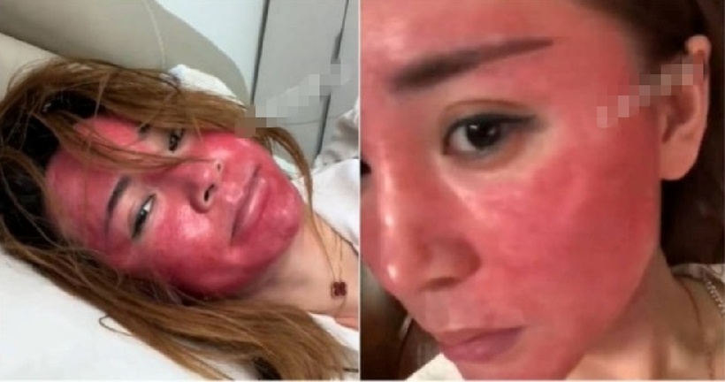 Trong suốt hai thập kỷ, cô Gao chưa bao giờ điều trị da liễu một cách khoa học. Ảnh: Hao Kan