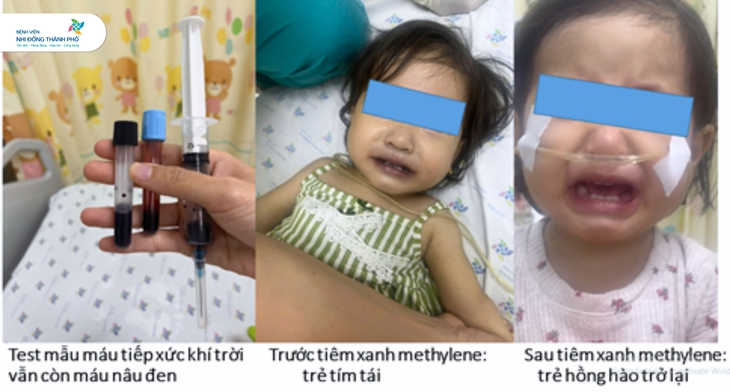 Bé gái 16 tháng tuổi bị methemoglobine máu (tức hồng cầu không gắn kết được với oxy để chuyển thành máu hồng) sau bữa ăn trưa. Ảnh: Bệnh viện cung cấp/TTO
