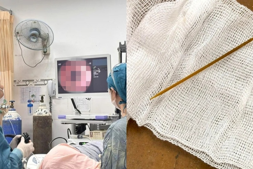 Các bác sĩ đã gắp ra cây tăm tre xỉa răng dài khoảng 5,5cm và không gây thêm tổn thương cho bệnh nhân. Ảnh: Báo Tuổi trẻ.