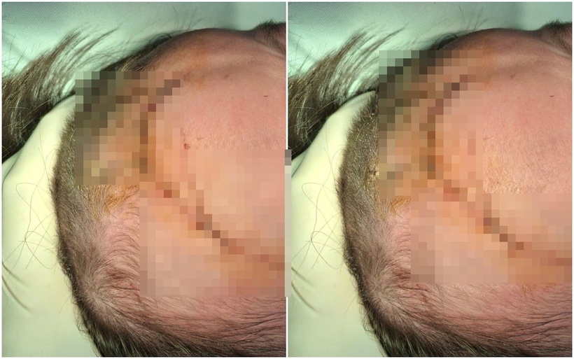 Bé trai 24 tháng tuổi bị chó cỏ cắn, vết thương nghiêm trọng vùng đầu. Ảnh: Tuổi trẻ Online