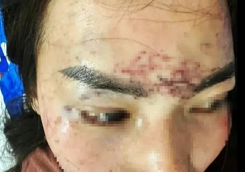 Nạn nhân cho rằng do ghen tuông nên đã đánh và xăm lên mặt. Ảnh: Tiền Phong