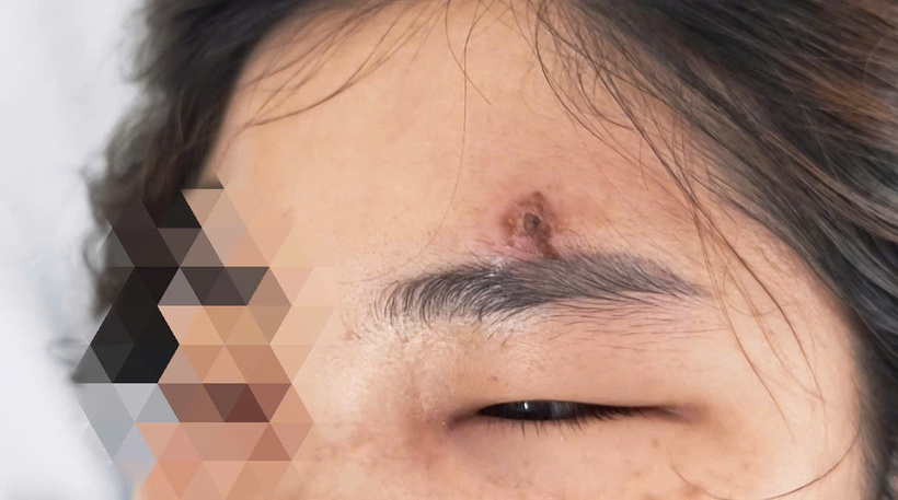 "Lỡ" tay nặn mụn khiến cô gái nhập viện