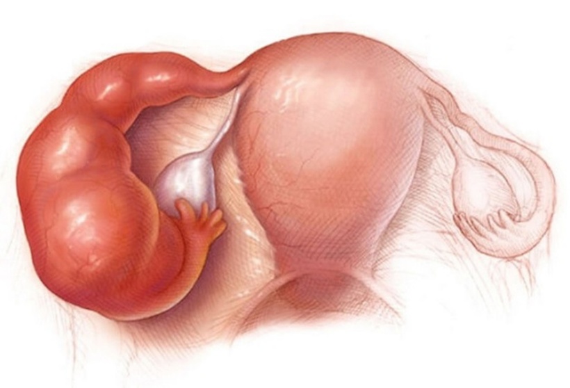 Có nhiều nguyên nhân dẫn đến vô sinh hiếm muộn, trong đó có tắc vòi tử cung, tinh trùng yếu. Ảnh minh họa