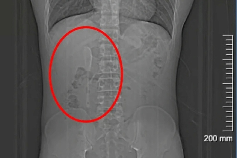 Chiếc thìa sứ dài 15cm bị kẹt trong cơ thể anh. Ảnh: QQ.