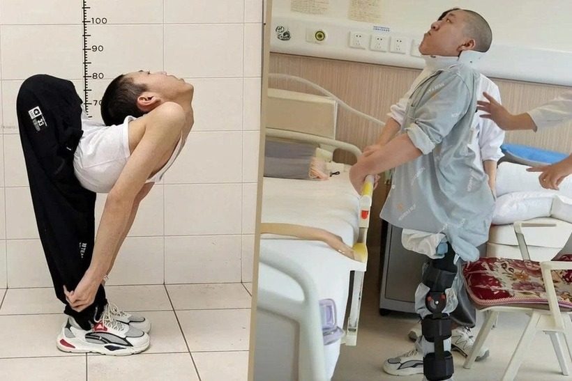 Jiang Yanchen trước và sau khi được phẫu thuật.