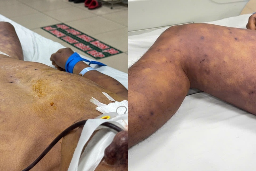 Anh H được phát hiện trong tình trạng lơ mơ tím tái toàn thân, tiêu chảy kèm máu sau 3 ngày ăn tiết canh. Ảnh: BVCC