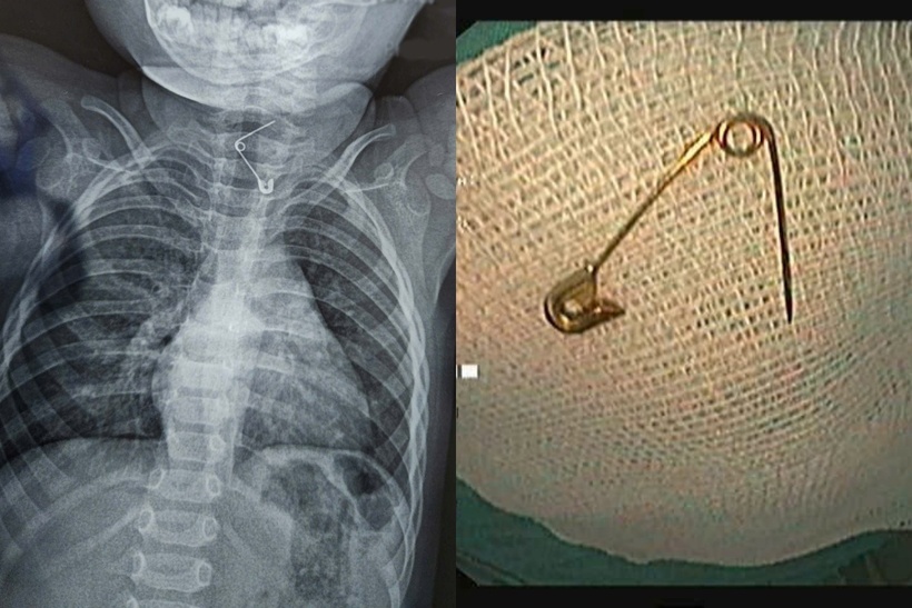 Cây kim băng dài khoảng 3 cm, đã bung ra thành hình chữ L. Ảnh: BVCC.