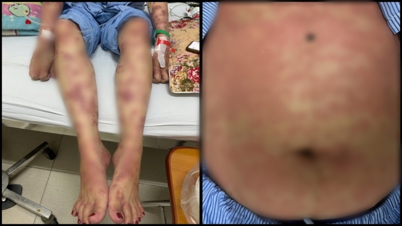 Các ban đỏ lan rộng ở mặt, tay chân, thân mình của bệnh nhân. Ảnh: Giáo Dục và Thời Đại