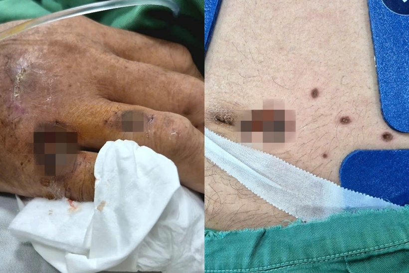 Trên vị trí cơ thể có nhiều vệt cháy ở hai gối, mu tay, quanh rốn và đầu dương vật, dấu hiệu điển hình nghi do điện giật. Ảnh: BVCC