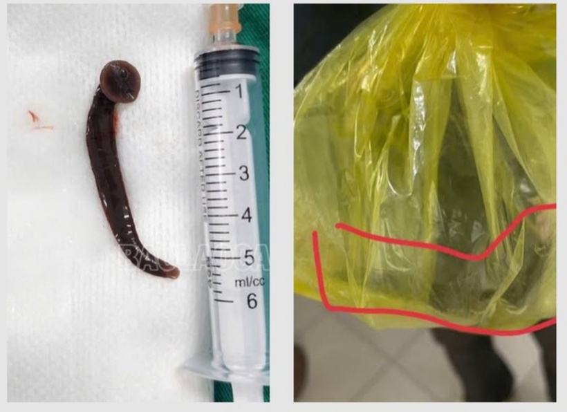 Hình ảnh con đỉa chui vào niệu đạo bệnh nhân khi đang làm đồng. Ảnh: Sức khỏe & Đời sống.