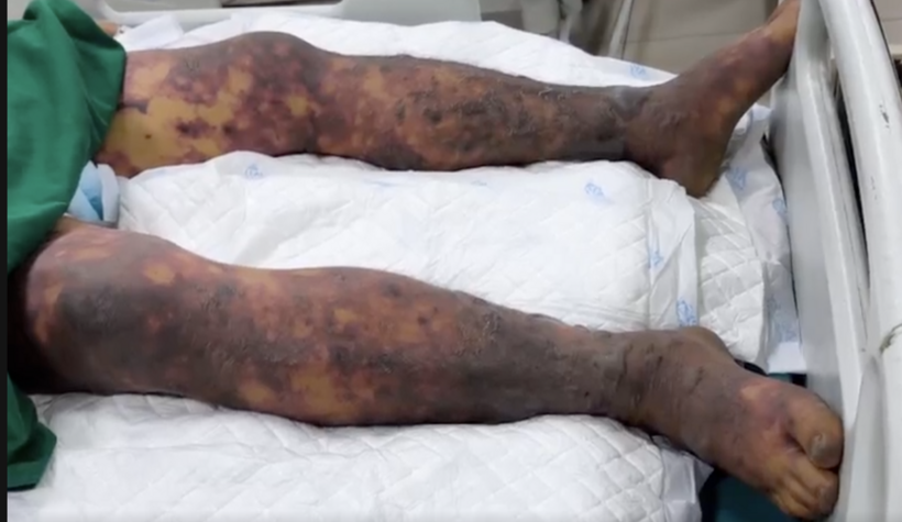 Hiện tại, bệnh nhân tạm thời ổn định nhưng vẫn đang trong giai đoạn đầu, nguy cơ diễn tiến nặng là rất cao. Ảnh: BVCC