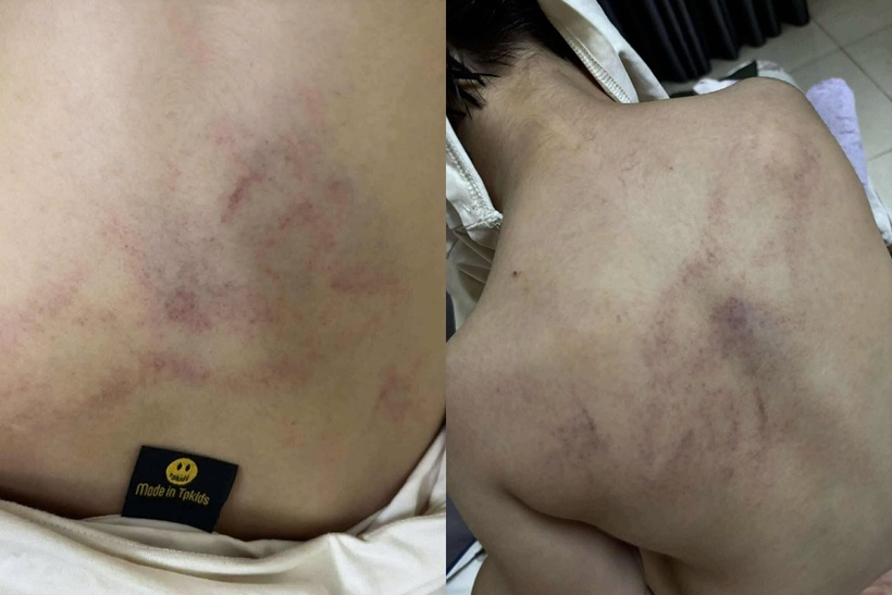 Hình ảnh bầm tím phía sau lưng bé gái. Ảnh: TT