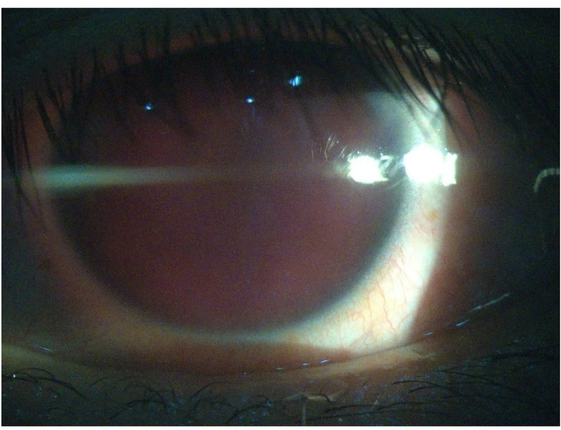 Hình ảnh mắt bệnh nhân bị xuất huyết tiền phòng toàn bộ. Ảnh: Sức khỏe & Đời sống.