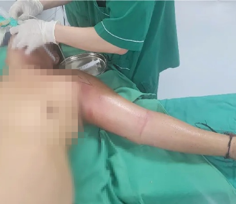 Tự tiêm mật gấu chữa đau ngực tại nhà, người đàn ông suýt mất mạng.