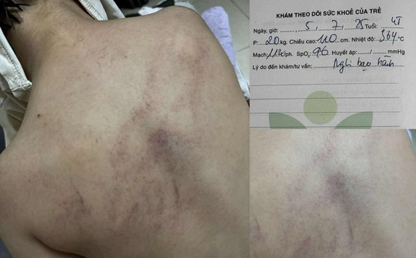 Các vết bầm tím trên cơ thể của bé gái 4 tuổi nghi bị cô giáo bạo hành. Ảnh: Gia đình & Xã hội