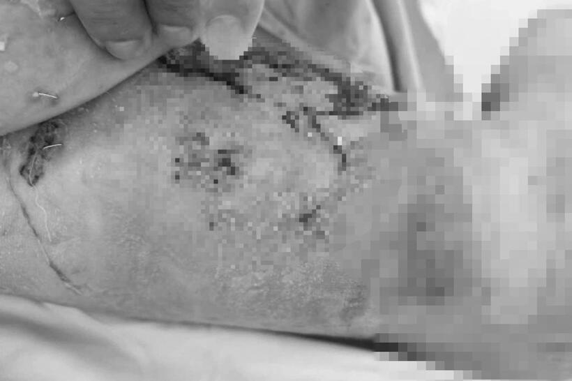 Bé trai nhập viện trong tình trạng bỏng nặng nề. Ảnh: Dân trí