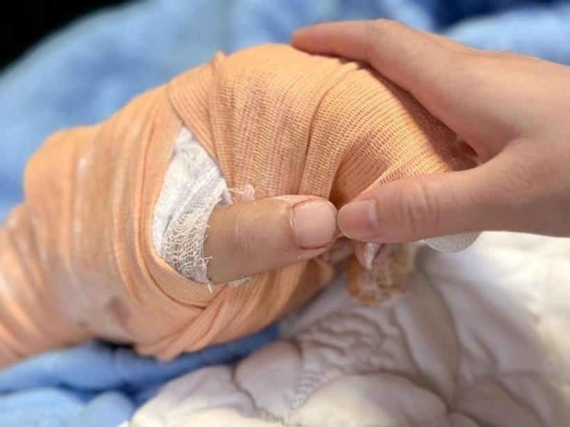 Bàn tay của bệnh nhân được nối thành công. Ảnh: Lao Động