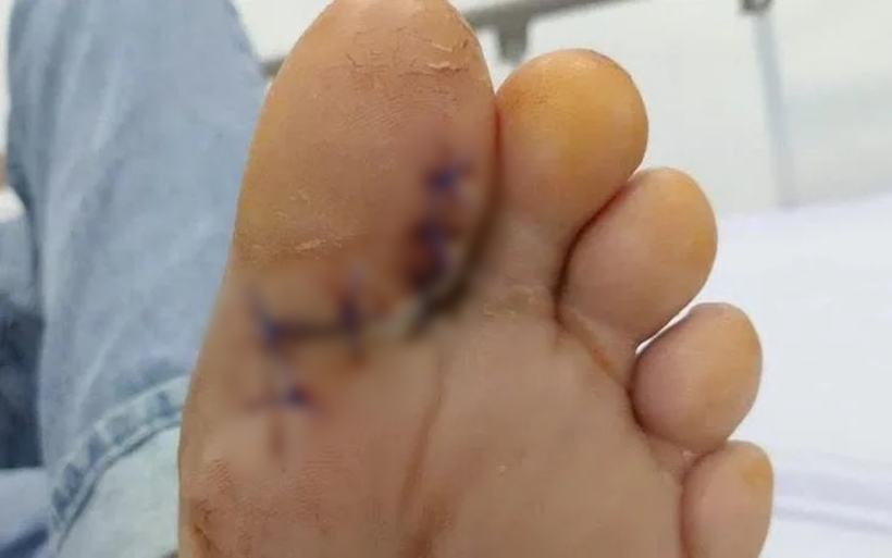 Người bệnh đi khám vì tổn thương lâu lành ở ngón I bàn chân trái kéo dài suốt một tháng. Ảnh: Thời báo VTV