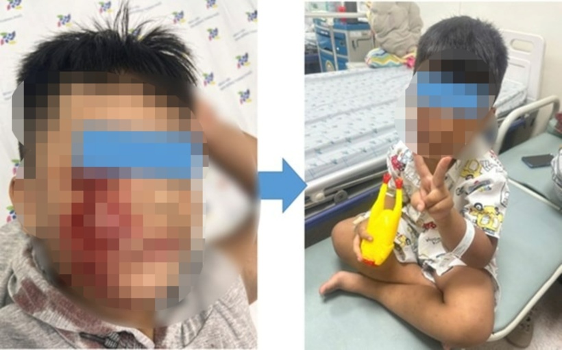 Vết thương bị chó cắn. Ảnh: Báo Lao Động.