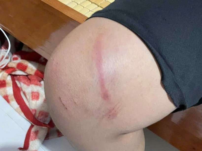 Qua những hình ảnh được ghi lại, cháu D bị nhiều vết bầm tím, sưng tấy ở vùng chân, lưng và đầu.