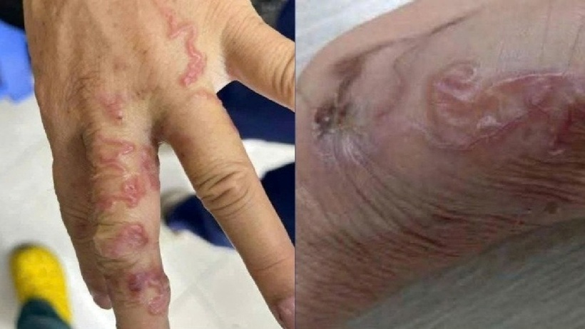 Ăn gỏi cá mè sống, người bệnh "sốc" khi phát hiện điều kinh hoàng dưới da. Ảnh: Tạp chí Tri thức.