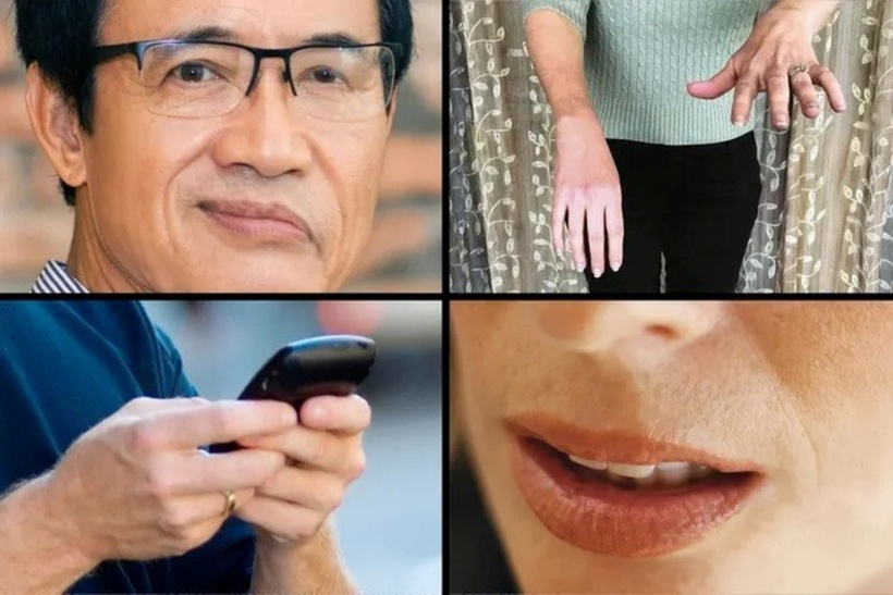 Chúng ta có thể nhận biết người bị đột quỵ do tai biến mạch máu não thông qua nguyên tắc FAST. Ảnh: WebMd.