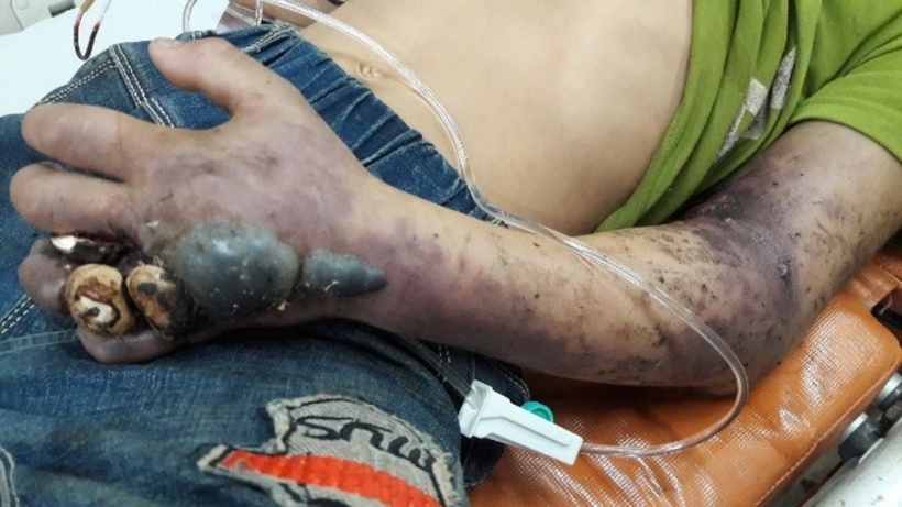 Các bệnh nhân rắn độc cắn tự dùng thuốc tại nhà, đến viện muộn khi đã nhiễm độc nặng, hoại tử rộng chân tay. Thuốc vẫn còn trên vết cắn hoặc dính ở chân. Ảnh: BS. Nguyễn Anh Tuấn, Trung tâm Chống độc