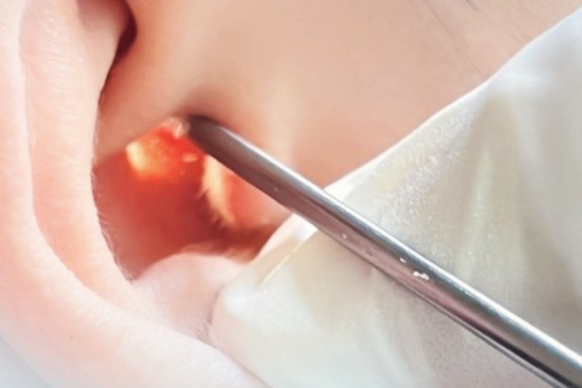 Nếu bạn bị chấn thương tai, hãy đến ngay cơ sở y tế có chuyên khoa tai mũi họng để được thăm khám và xử lý kịp thời. Việc này rất quan trọng để tránh các biến chứng nghiêm trọng. Ảnh minh họa.