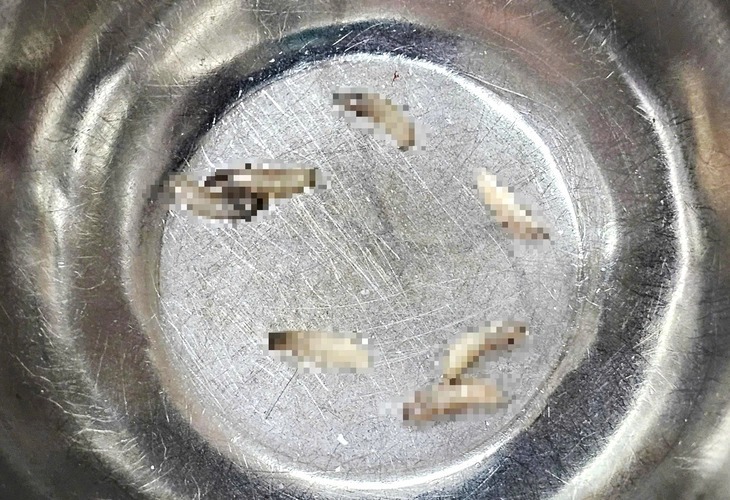 Ổ 7 con giòi được gắp ra từ hốc mũi bệnh nhân. Ảnh: Tuổi trẻ