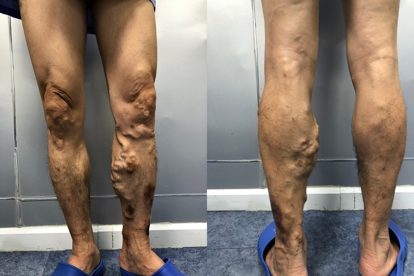 Hình ảnh bệnh nhân suy giãn tĩnh mạch nặng. Ành: BSCC