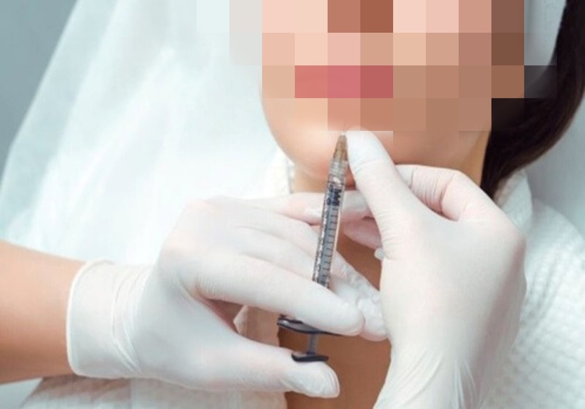 FDA chỉ cấp phép cho tiêm filler để tăng thể tích cho các vùng ở mặt (môi, má, cằm) và bàn tay...Ảnh minh họa