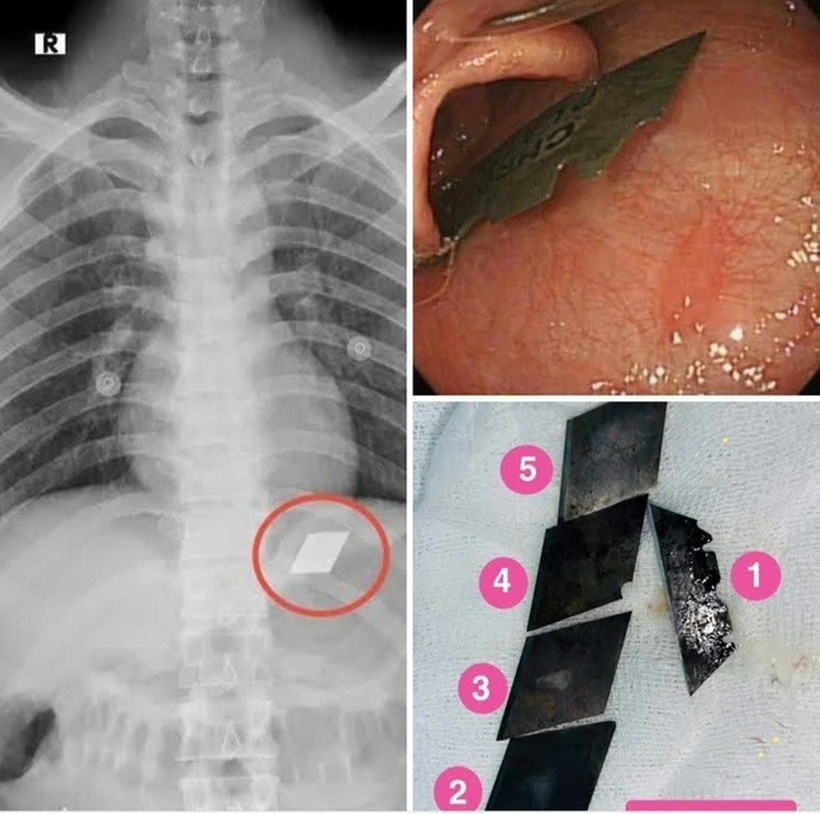 Cứu sống người đàn ông nuốt 4 lưỡi dao rọc giấy vào bụng. Ảnh: Báo Người lao động.