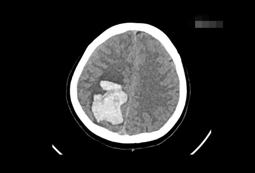 Hình ảnh xuất huyết não của thai phụ mang thai ở tuần 19. Ảnh: BSCC