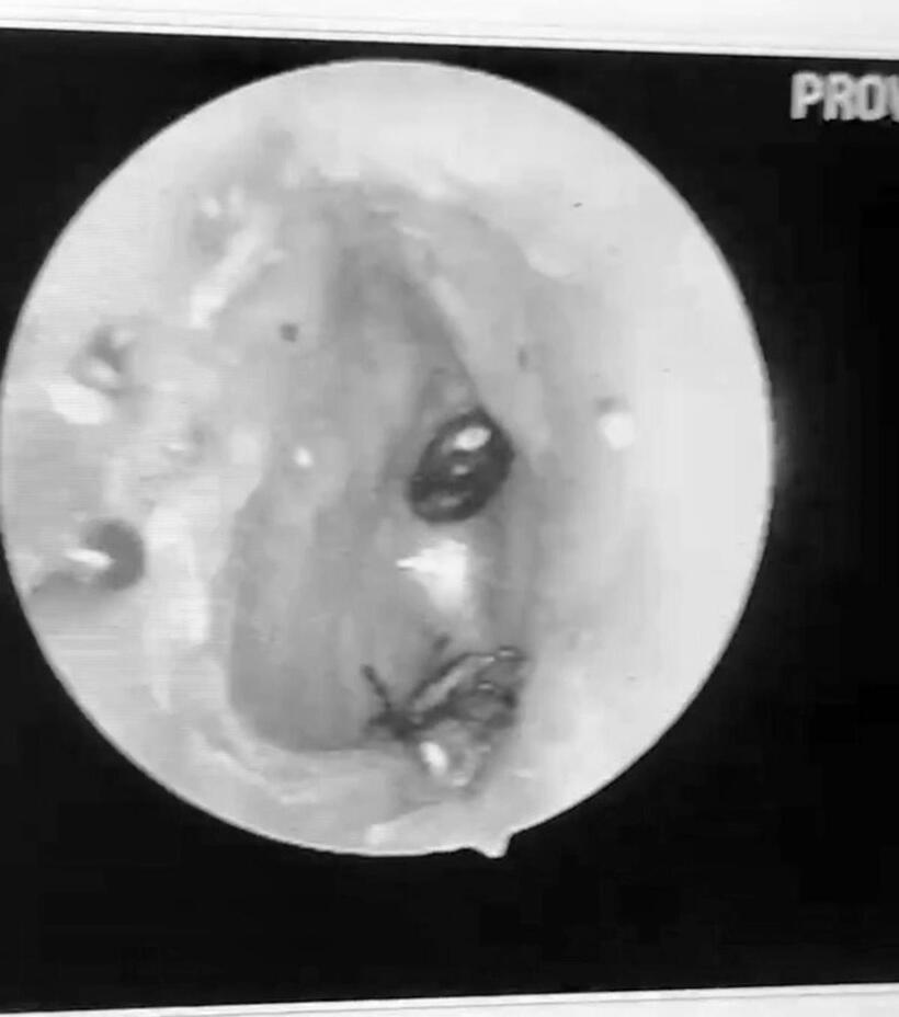 Hình ảnh ve chó ký sinh trong ống tai bệnh nhân. Ảnh: Sức Khỏe & Đời Sống