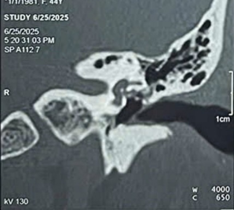 Kết quả chụp CT-scan tai cho thấy bệnh nhân bị vỡ xương thái dương ở hòm nhĩ trái, kèm theo vỡ cửa sổ bầu dục, xương bàn đạp di lệch vào tiền đình và gián đoạn xương đe - bàn đạp. Ảnh: Tạp chí Tri Thức.