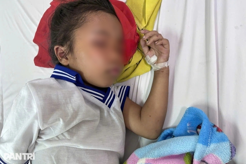 Bé gái 7 tuổi được chẩn đoán bị ong khoái đốt gây bội nhiễm, tổn thương giác mạc phải. Ảnh: Dân Trí