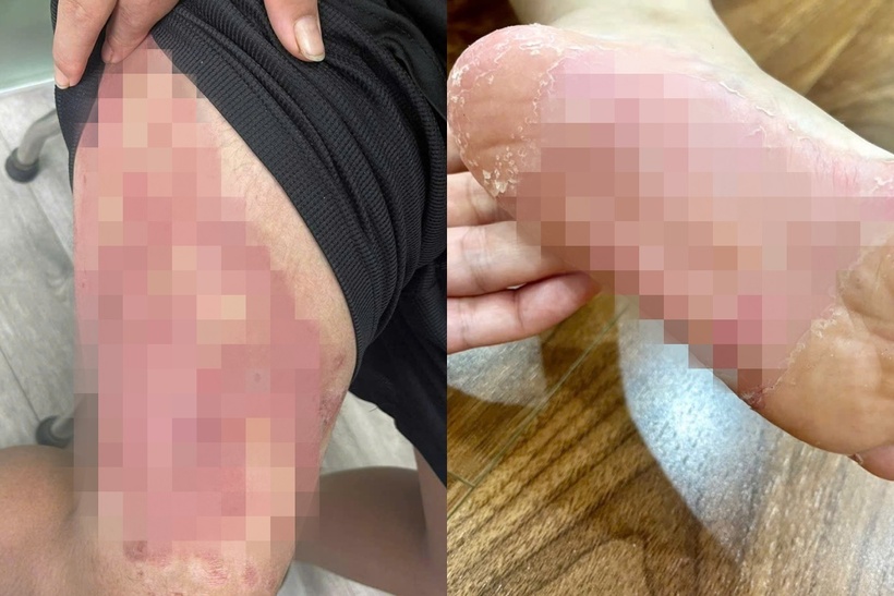 Nhiều căn bệnh sau bão dễ gặp, nếu không xử lý đúng cách có thể dẫn đến biến chứng nặng. Ảnh: BSCC