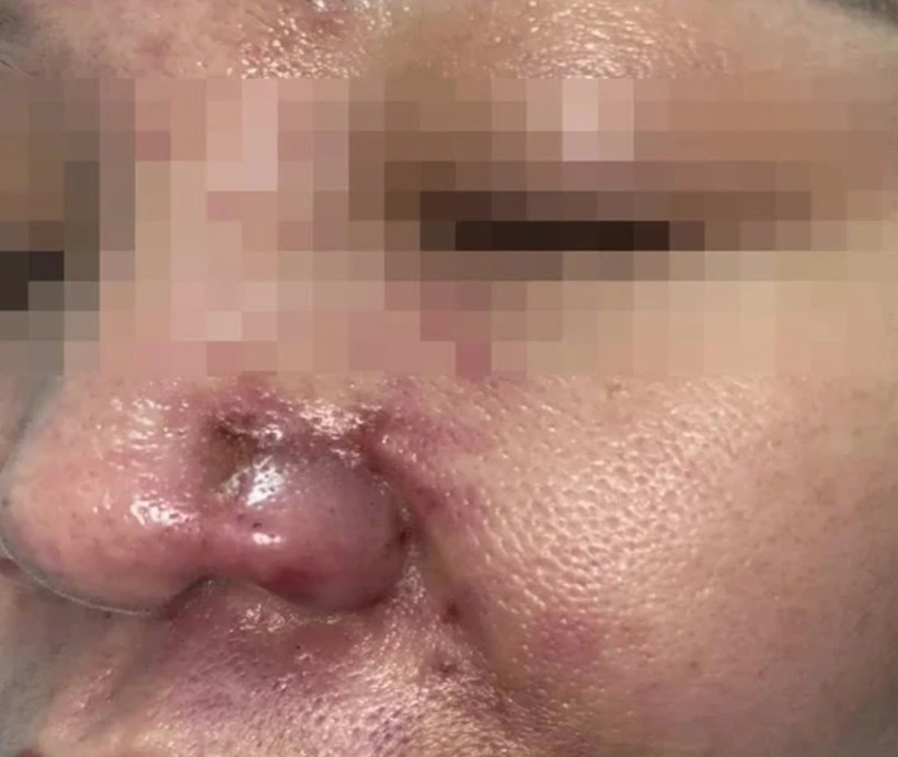Phần lớn các ca tai biến thẩm mỹ do thực hiện tại các cơ sở không được phép, người thực hiện không phải là bác sĩ chuyên khoa. Ảnh: Dân trí