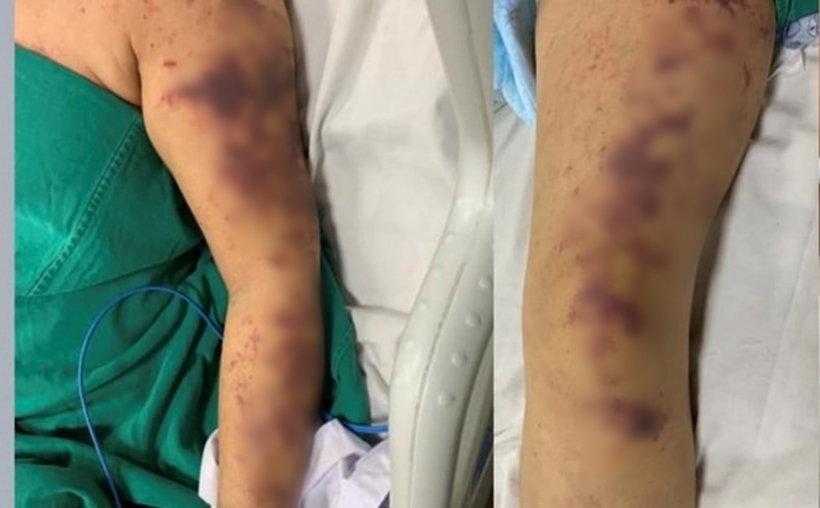 Biểu hiện của người bệnh mắc bệnh liên cầu lợn. Ảnh: Lao Động