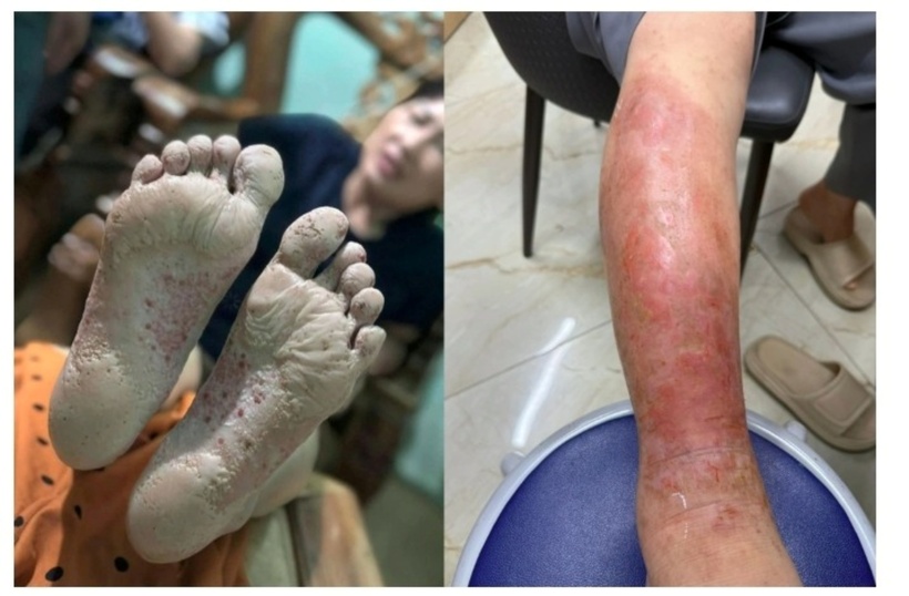 Hậu mưa lũ dễ xuất hiện các bệnh về da. Ảnh: VOV.