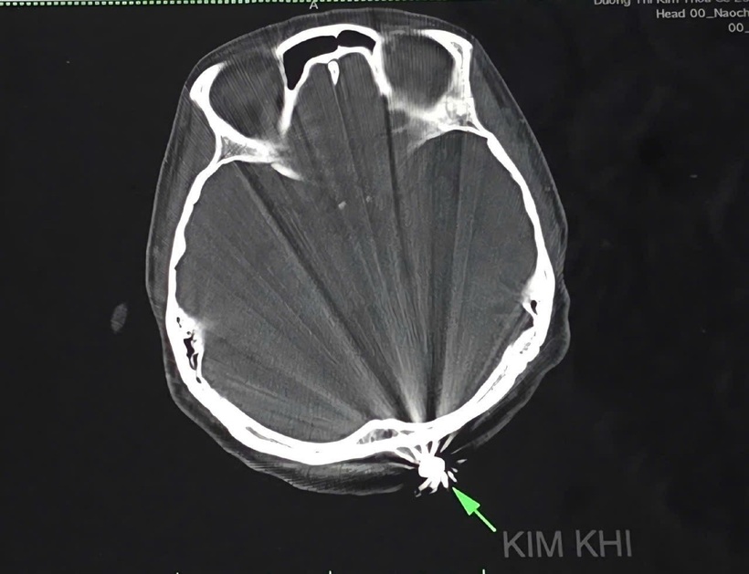Hình kim khí (viên đạn) trên phim chụp cắt lớp vi tính. Ảnh: Dân Trí