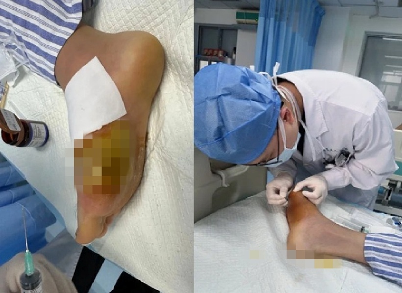 Sau khi chọc hút ổ viêm, bác sĩ thu được lượng lớn mủ đặc. Ảnh: QQ.